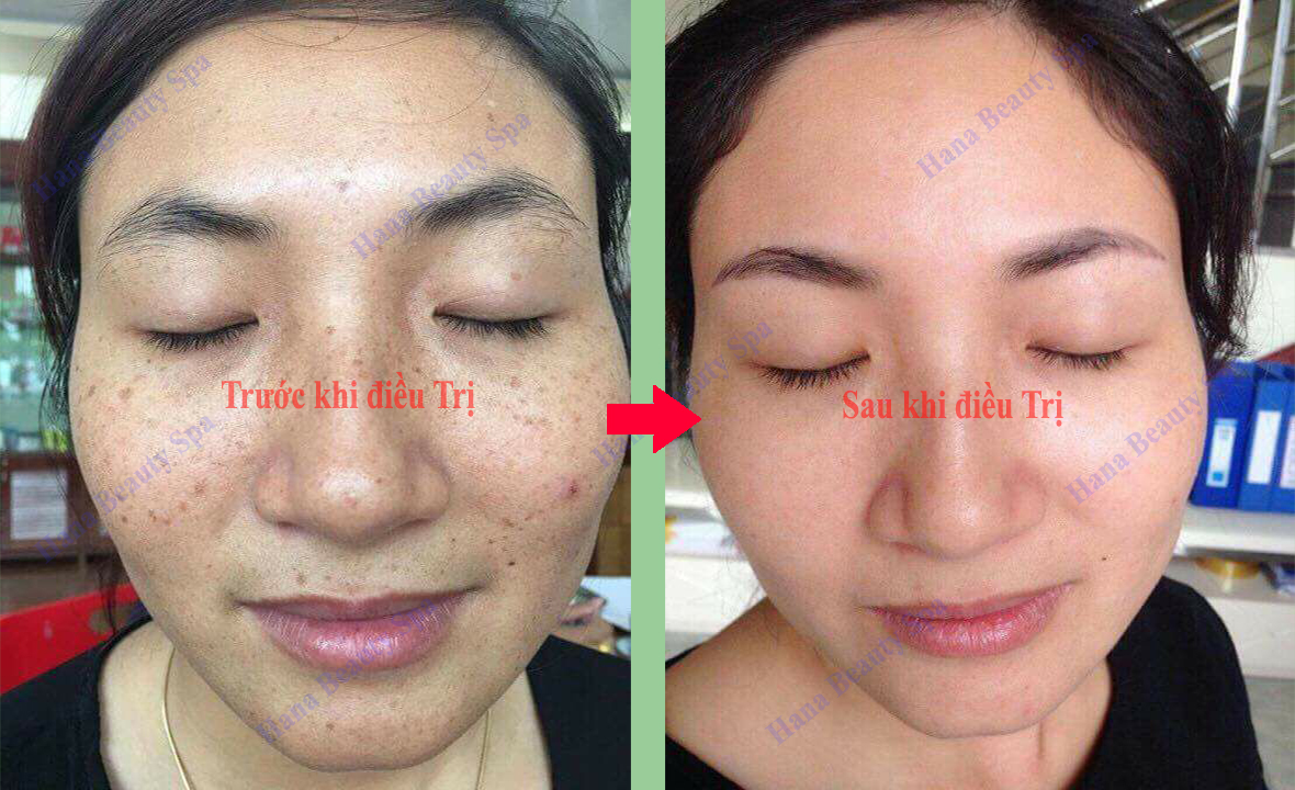 Điều trị nám, tàn nhang bằng máy Công nghệ cao