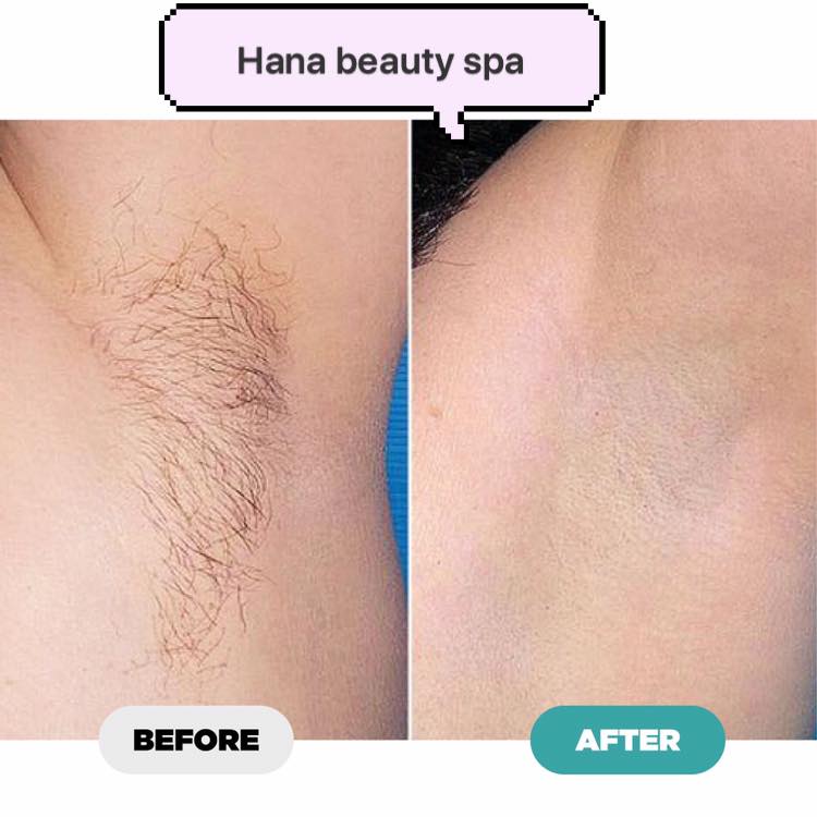 Triệt Lông trọn đời tại Hana Beauty Spa