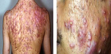 MỤn KhÓ TrỊ LiỆu