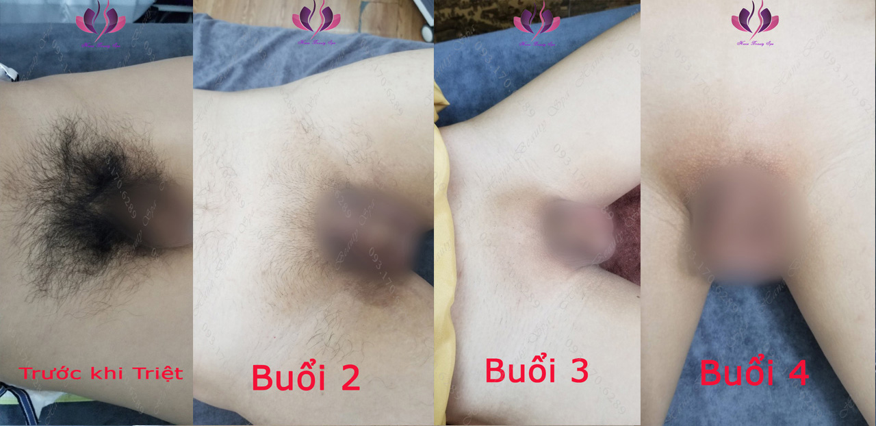 Triệt Lông Vùng Kín Cho Nam Giới