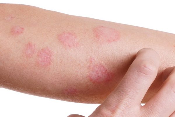 Lưu ý khi triệt lông vĩnh viễn