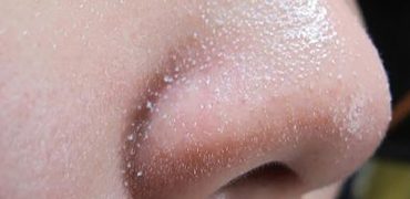 Cach Tri Mun Cam O Mui