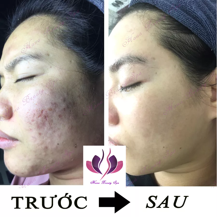 mibery gel 4 trị mụn có tốt không 3 Ảnh Mặt 8 (3)