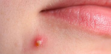 10 Cach Tri Mun Mu Viem Sung To Sieu Hieu Qua Ngay Tai Nha 18411