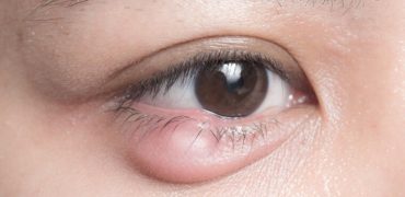 10 Meo Chua Leo Mat Don Gian Tai Nha Hieu Qua Nhanh Chong 202201192245082882