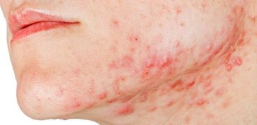 20210927 Rat Nhieu Nguoi Phai Doi Mat Voi Tinh Trang Mun Quai Ham (1)