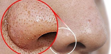 20221103 083346 583813 Cach Tri Mun Dau De.max 1800x1800