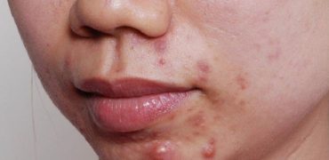 3xm3u8ch Mun Moc Quanh Mieng 1