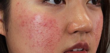 Cach Tri Mun Sung Do(1)