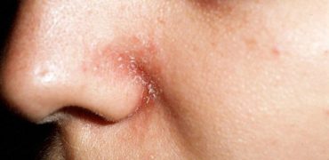 Da Mui Bi Kho Hinh Anh 1