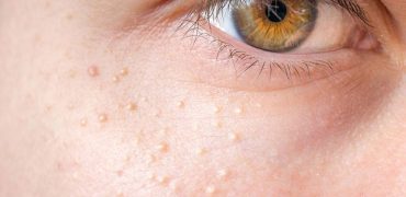 Mun Thit Milia La Gi 01 Getty Images