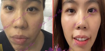 Sửa Xong Mụn Chán 900 A1