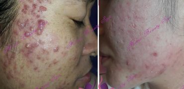 Sửa Xong Mụn Chán 900 A3