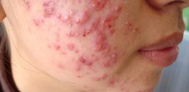 Thuoc Tri Mun Cho Da Nhon Bi Mun Boc 1