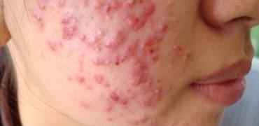 Tri Mun Viem Tan Goc 01 (1)