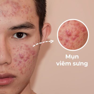 Trị mụn sưng viêm 1 trị mụn sưng viêm