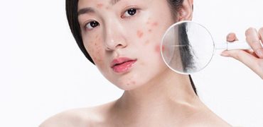 TrỊ MỤn HiỆu QuẢ