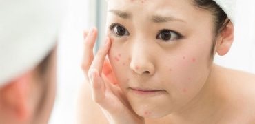 Cach Tri Mun O Tuoi Day Thi