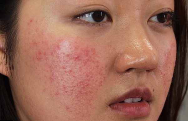 điều trị mụn