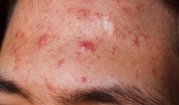 Trị mụn trán