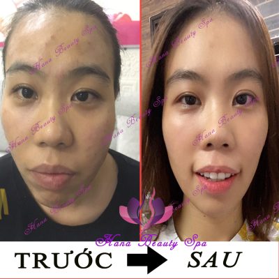 điều trị mụn trước & sau tại HANA BEAUTY SPA