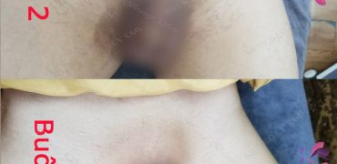 Triệt Lông Vùng Kín Cho Nam Giới