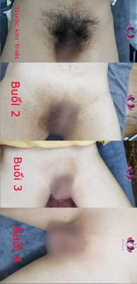 Triệt Lông Vùng Kín Cho Nam Giới